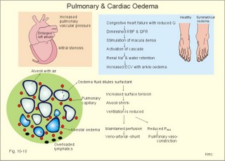 pulmonary oedema