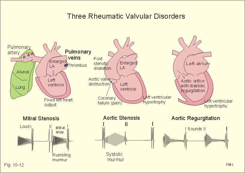 Aortic stenosis and regurgitation