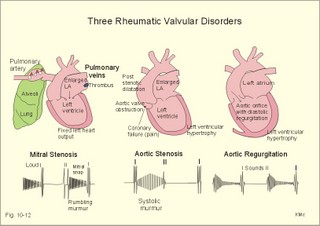 Mitral stenosis