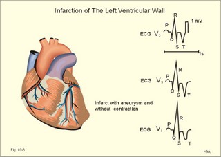 myocardial infarction