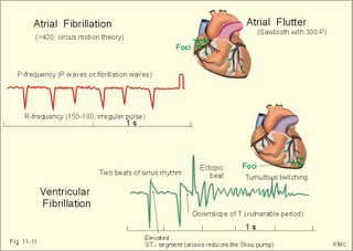 left atrial fibrillation