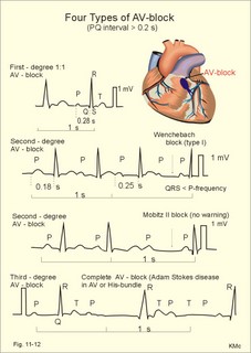 atrio-ventricular block