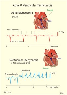 Left atrial tachycardia