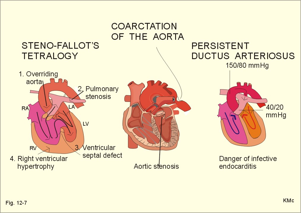  exertion syncope, and paradoxical emboli from veins to systemic arteries 