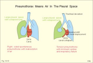 pneumothorax