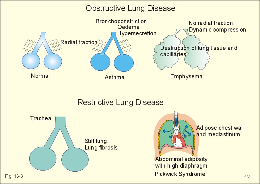 What are some causes of inflammatory lung disease?