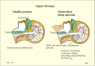 sleep apnea