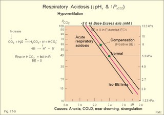 Acute respiratory acidosis