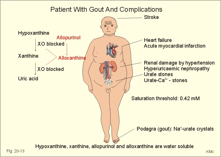 Blockage of the uric acid 