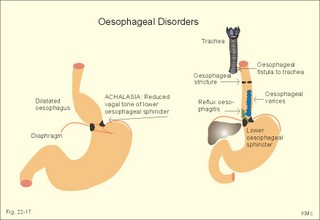 oesophageal disorders