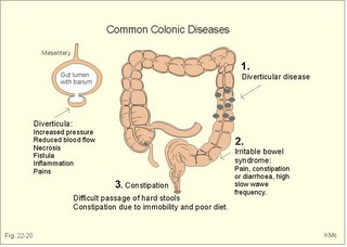 Colonic disorders