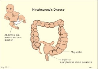 Hirschprungs disease
