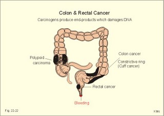 Colon cancer