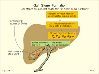 gallstones