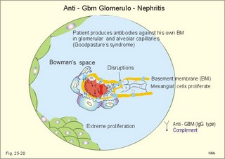 glomerulonephritis anti-GBM