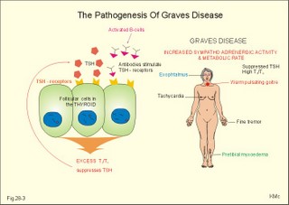 graves disease