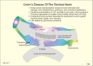 Crohn's disease