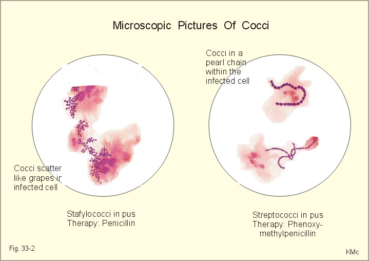 impetigo in adults. Staphylococci present in the