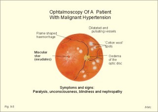 hypertonic changes