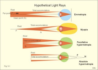 light rays in emmetropic, myopic