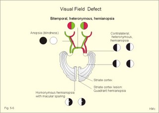 visual field defects