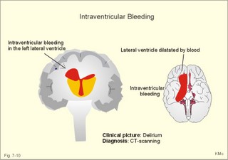 Subarachnoid and intraventricular bleeding 