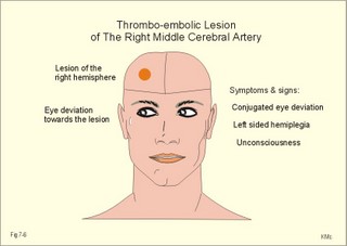 A stroke patient