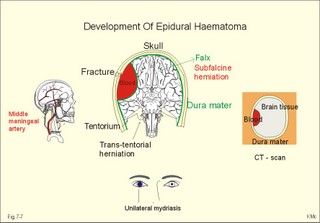 Development of epidural haematoma