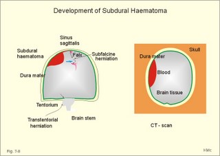 Development of subdural haematoma