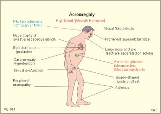 Clinical features of acromegaly