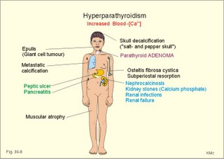 Hyperparathyroidism