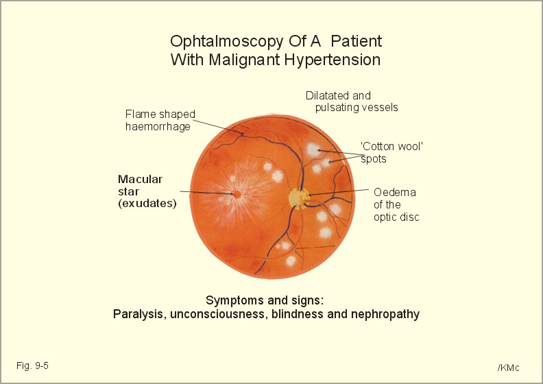 Hipertóniás retinopathia - Hypertensive retinopathy - varkertetterem.hu