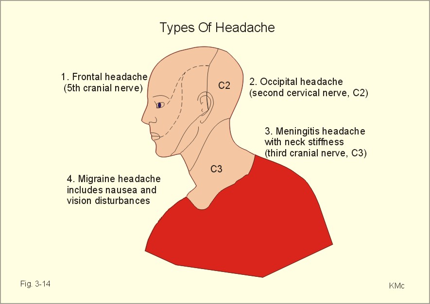 Headache Location Chart Meaning